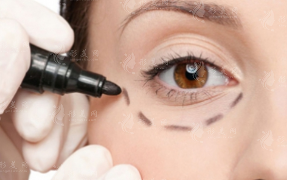 激光去眼袋：好處與壞處的全面解析