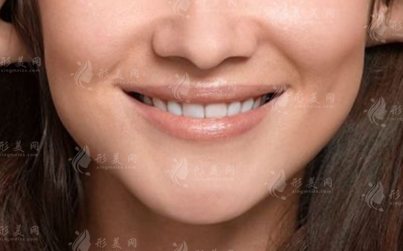 法令紋填充能保持多久？常見填充劑一覽