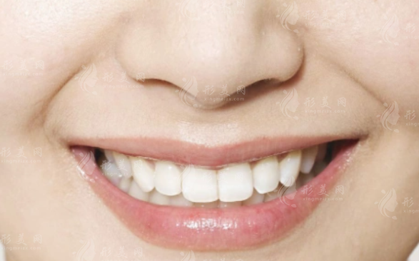 鼻唇溝與法令紋：解析兩者之間的微妙差異