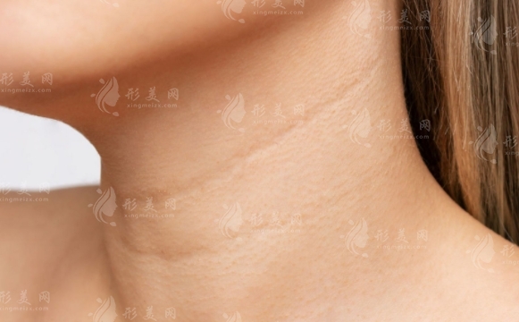 頸部拉皮手術(shù)：全麻還是局麻？手術(shù)風(fēng)險解析