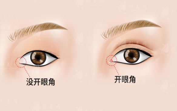 開大外眼角手術(shù)的方法及注意事項(xiàng)