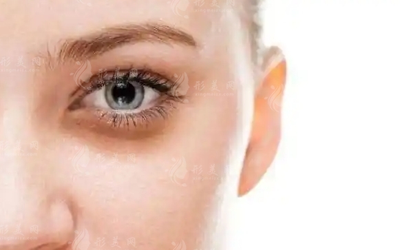 非手術(shù)祛眼袋：不手術(shù)也能撫平歲月的痕跡