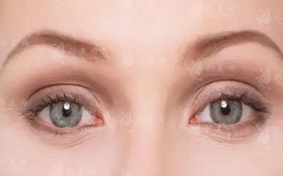 激光祛眼袋手術(shù)：注意事項(xiàng)與優(yōu)勢(shì)解析