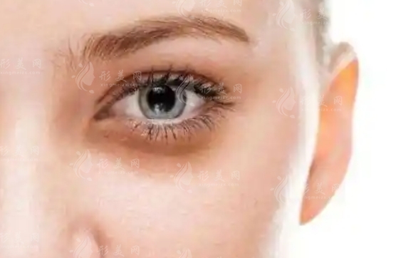 去眼袋手術(shù)失敗后的希望之光：眼袋修復(fù)手術(shù)，重拾自然之美