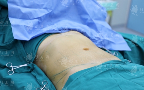 抽脂術(shù)后會(huì)復(fù)胖嗎？分享抽脂術(shù)后正確觀念