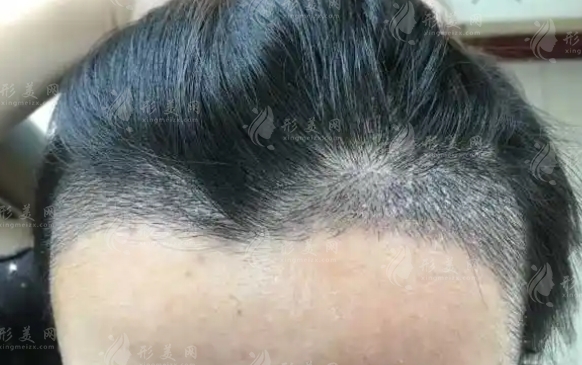 植發(fā)一次要取多少毛囊？微針植發(fā)技術(shù)詳解