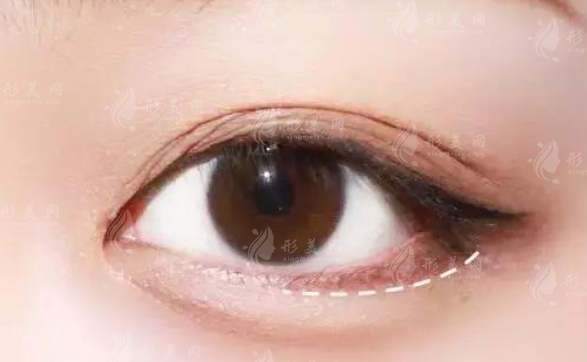 有臥蠶與無(wú)臥蠶：區(qū)別與優(yōu)勢(shì)解析