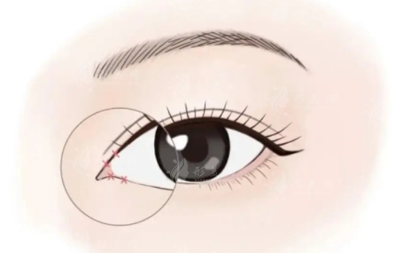 內(nèi)眼角開(kāi)太大了怎么辦？?jī)?nèi)眼角修復(fù)是否可行？