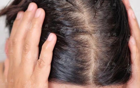 微針植發(fā)的優(yōu)勢(shì)：你不了解的微針知識(shí)解答！