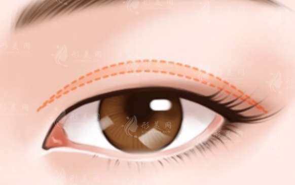 雙眼皮吸脂后，脂肪還會(huì)長嗎？會(huì)出現(xiàn)松弛嗎？