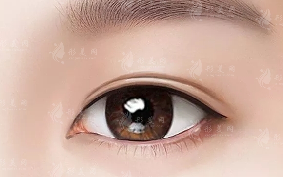 哪些人適合做埋線重瞼術(shù)？