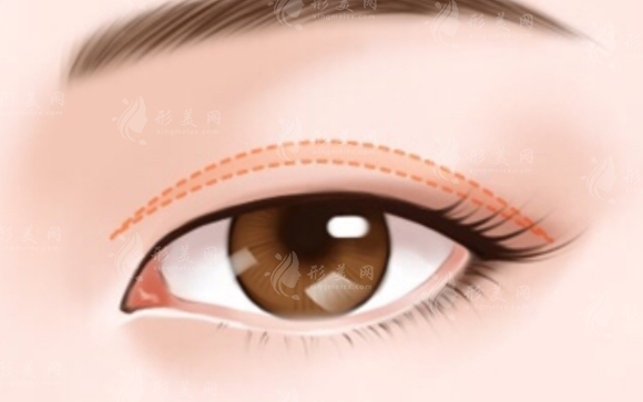 雙眼皮為何越來越寬？探究其背后的主要原因