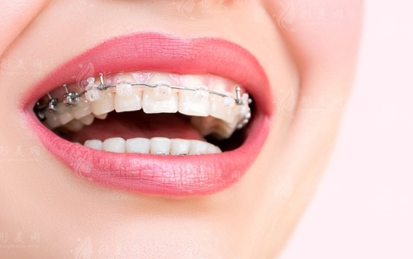  凸嘴矯正一般需要多少錢？術(shù)后注意事項(xiàng)有哪些？