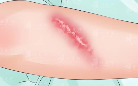 疤痕修復手術：次數與費用詳解