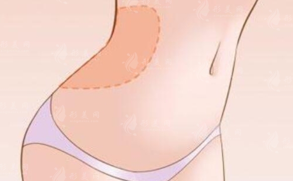 腰腹環(huán)吸抽脂：恢復(fù)期與后遺癥解析