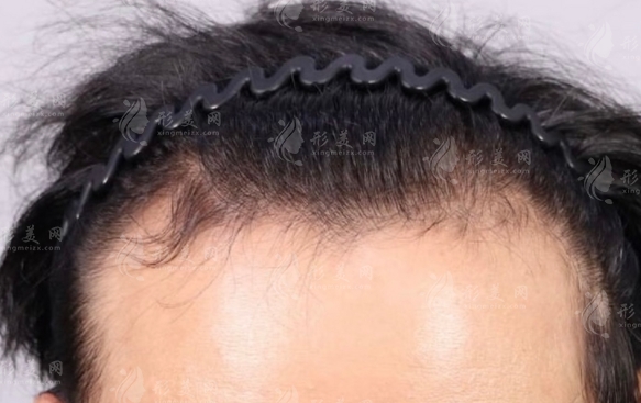 植發(fā)技術(shù)比較：植發(fā)與有痕植發(fā)哪個(gè)好？