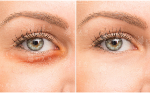 眼袋切除術全解析：費用、恢復與持久性