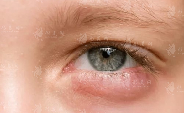 眼袋嚴重，激光手術是合適的選擇嗎？