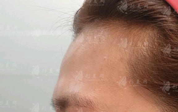 填充額頭：選擇何種方法比較？兩種優(yōu)質(zhì)材料解析