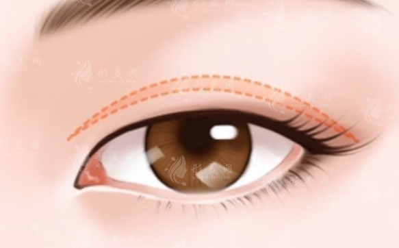 割雙眼皮與埋線：哪個(gè)更好？維持時(shí)間是關(guān)鍵