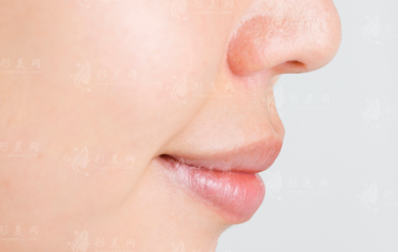 鼻唇溝去除手術(shù)：方法多樣，效果各異