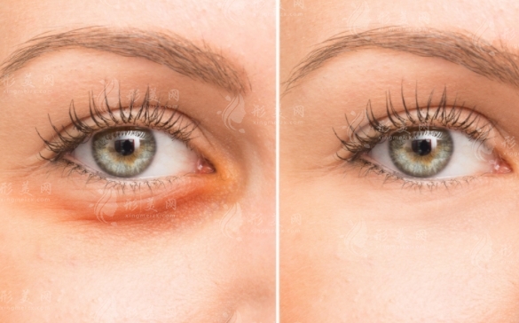 內(nèi)切去眼袋手術風險及恢復時間