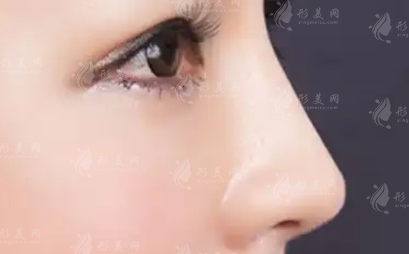 鼻尖縮小手術(shù)：效果與恢復(fù)指南