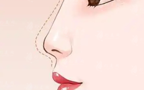 耳軟骨隆鼻尖恢復(fù)時(shí)間及護(hù)理方法