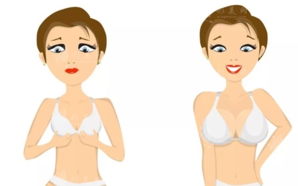 假體隆胸與自體脂肪隆胸：優(yōu)勢對比