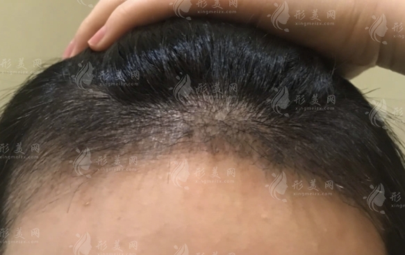 哪些因素影響自體毛發(fā)移植價(jià)格？