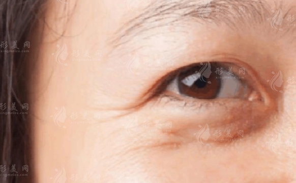 注射去魚尾紋：哪些材料比較好？