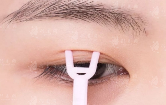 三點式雙眼皮：適合哪些人群的美麗選擇