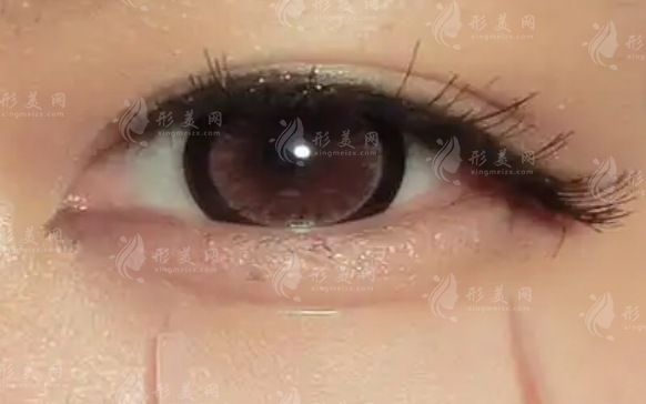 膠原蛋白打臥蠶：安全與持久性的探討