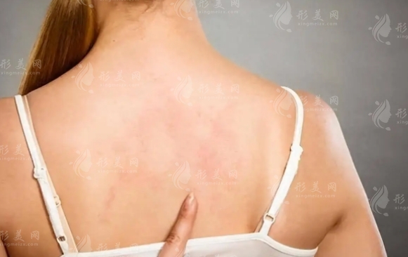 背部吸脂：常識(shí)、風(fēng)險(xiǎn)與并發(fā)癥