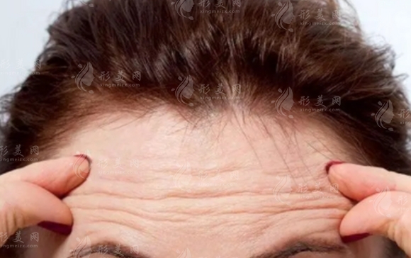 額頭上有很深的抬頭紋怎么辦？如何消除？