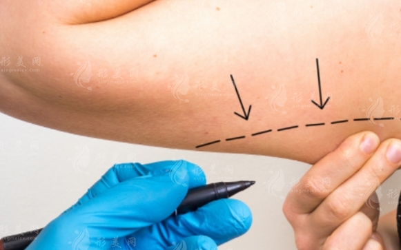微創(chuàng)吸脂手術(shù)及其優(yōu)點(diǎn)