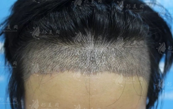 微針植發(fā)的優(yōu)勢與適應(yīng)癥