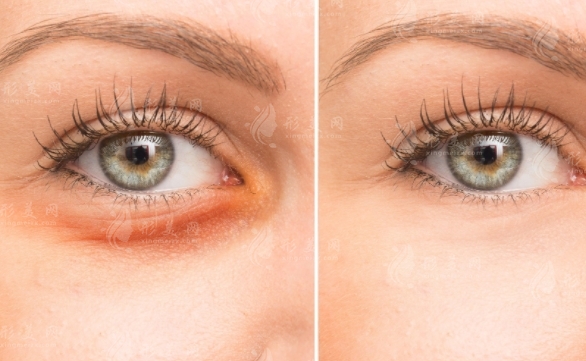 內(nèi)切眼袋與外切眼袋：探索哪種手術適合您的明眸之選