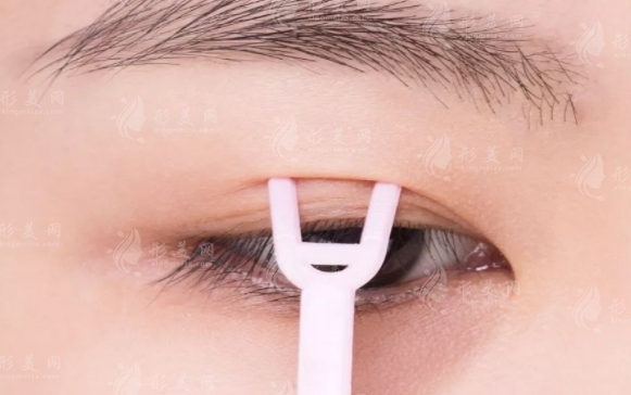 定點雙眼皮的方法和步驟