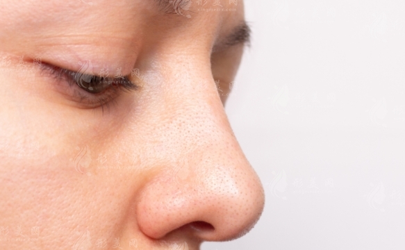 鼻翼肥厚太大怎么調(diào)節(jié)？鼻翼肥厚該如何處理？