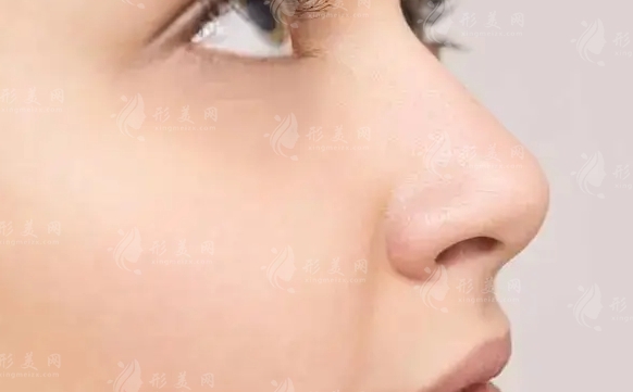 延長(zhǎng)鼻小柱與墊鼻尖：兩種鼻部整形手術(shù)的區(qū)別