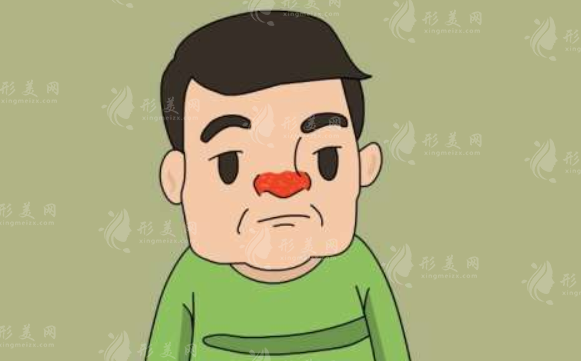  酒糟鼻術(shù)后會復發(fā)嗎？應對策略有哪些？