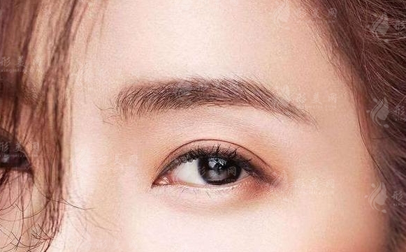 膨體隆眉弓：會移位嗎？有哪些風(fēng)險？