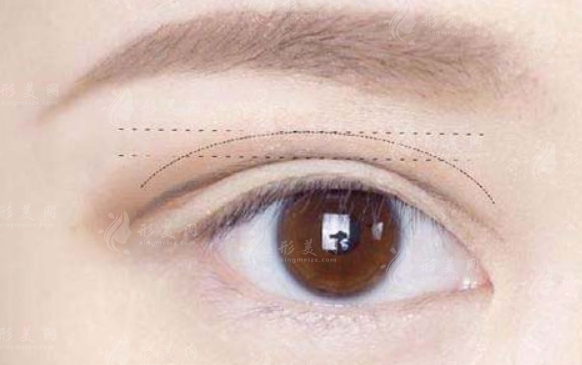 埋線雙眼皮取線流程一覽