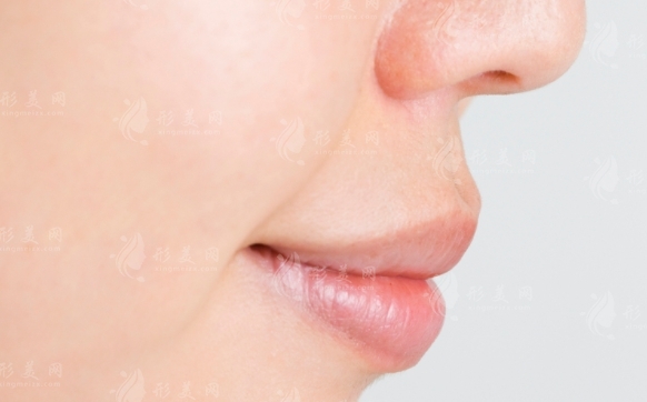 自體脂肪填充鼻唇溝：效果維持與收費價格解析