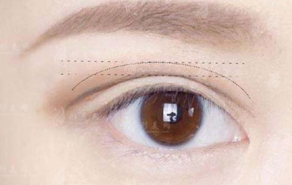 埋線雙眼皮：是否需要割開？答案因情況而異