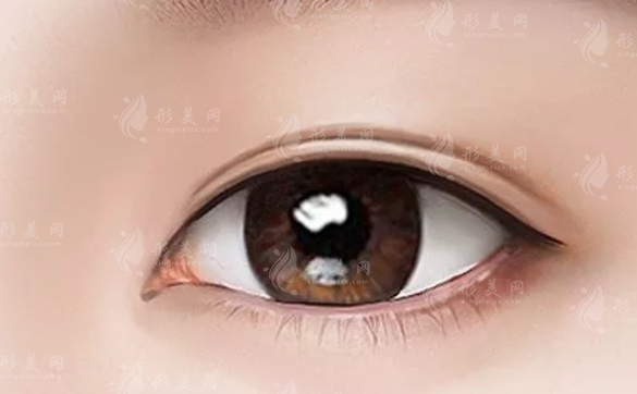 割雙眼皮眼角增生怎么辦？解決方法全解析