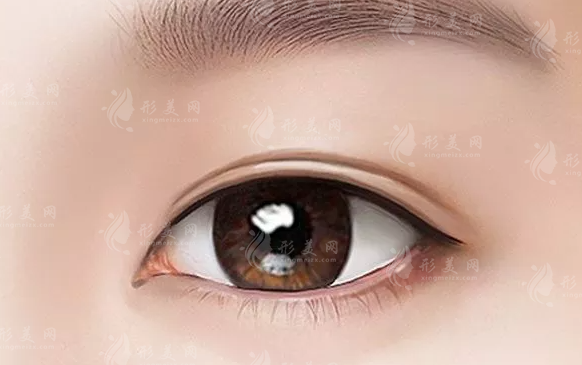 雙眼皮增生修復(fù)：恢復(fù)時間的探討