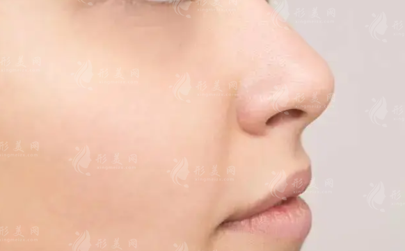 鼻尖整形的常見(jiàn)方法