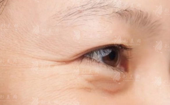 小切口除皺去魚(yú)尾紋：術(shù)后注意事項(xiàng)詳解